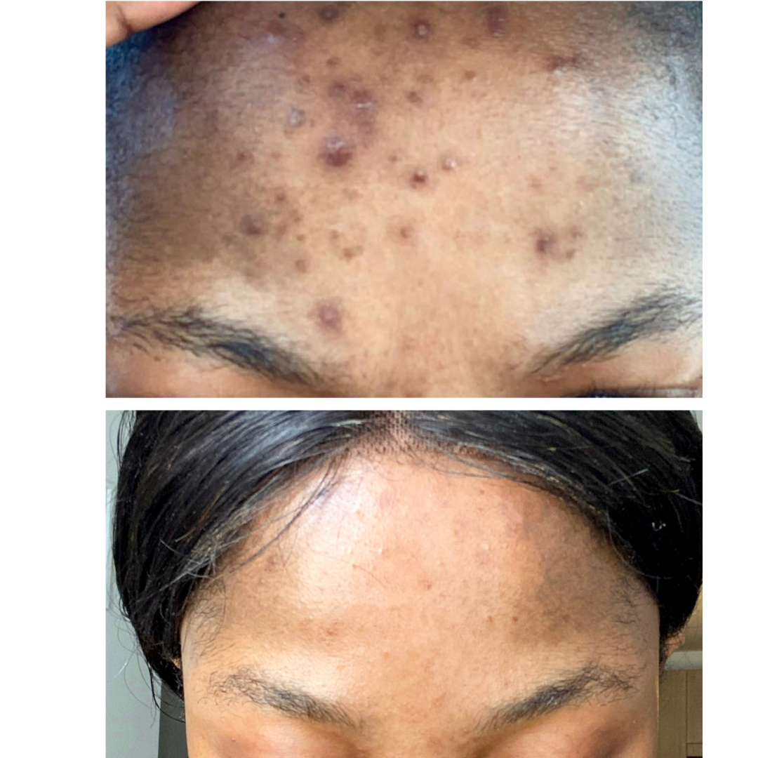 Intense Discoloration Treatment