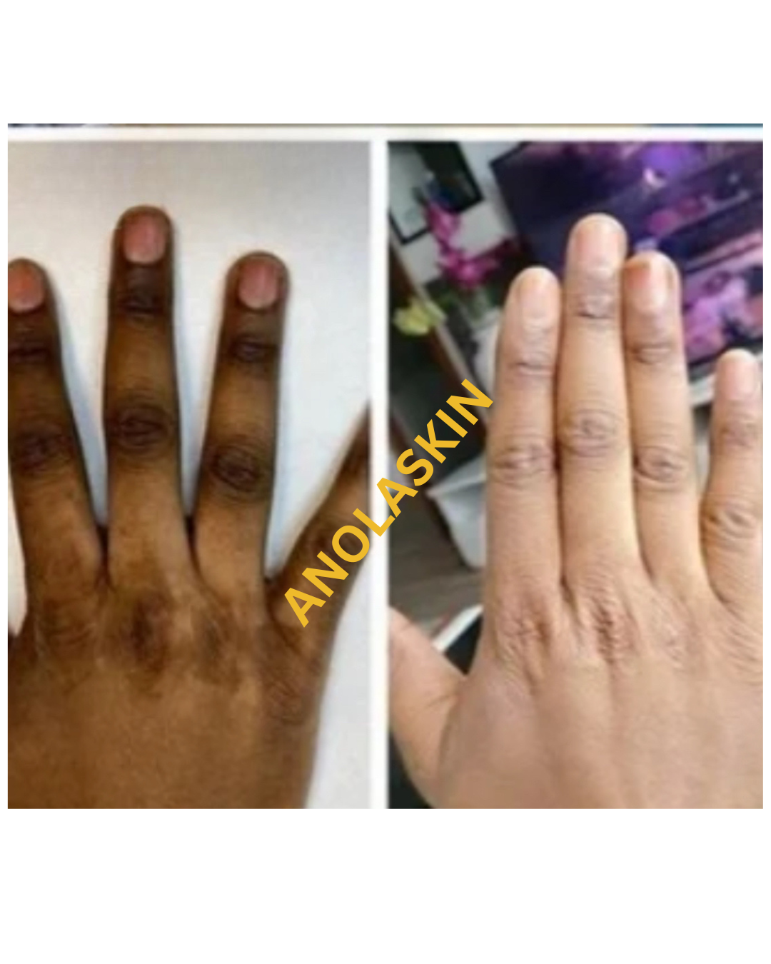 Dark Knuckles, Knees, Elbows, & Feet Lightening Serum