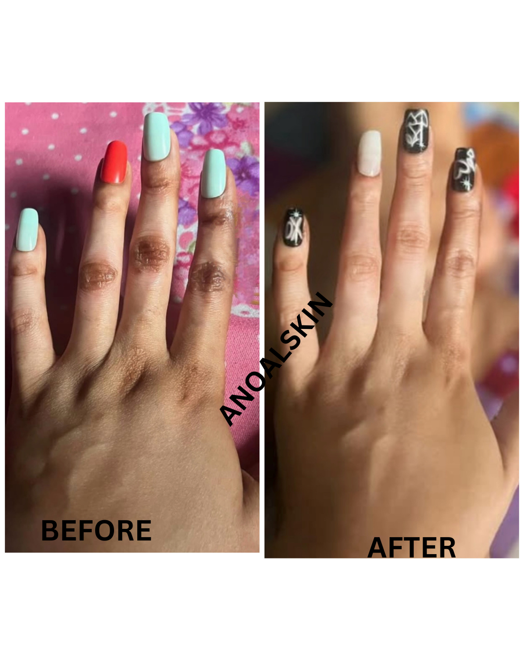 Rapid Fading Dark Knuckle Treatment (Results Driven )