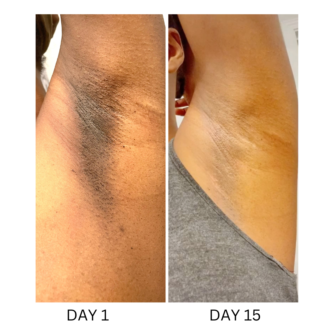 Intense Discoloration Treatment