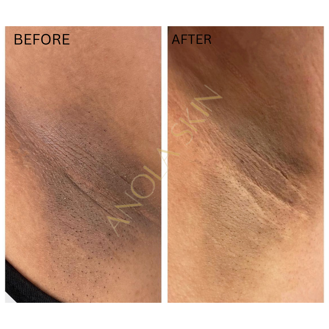 Intense Discoloration Treatment