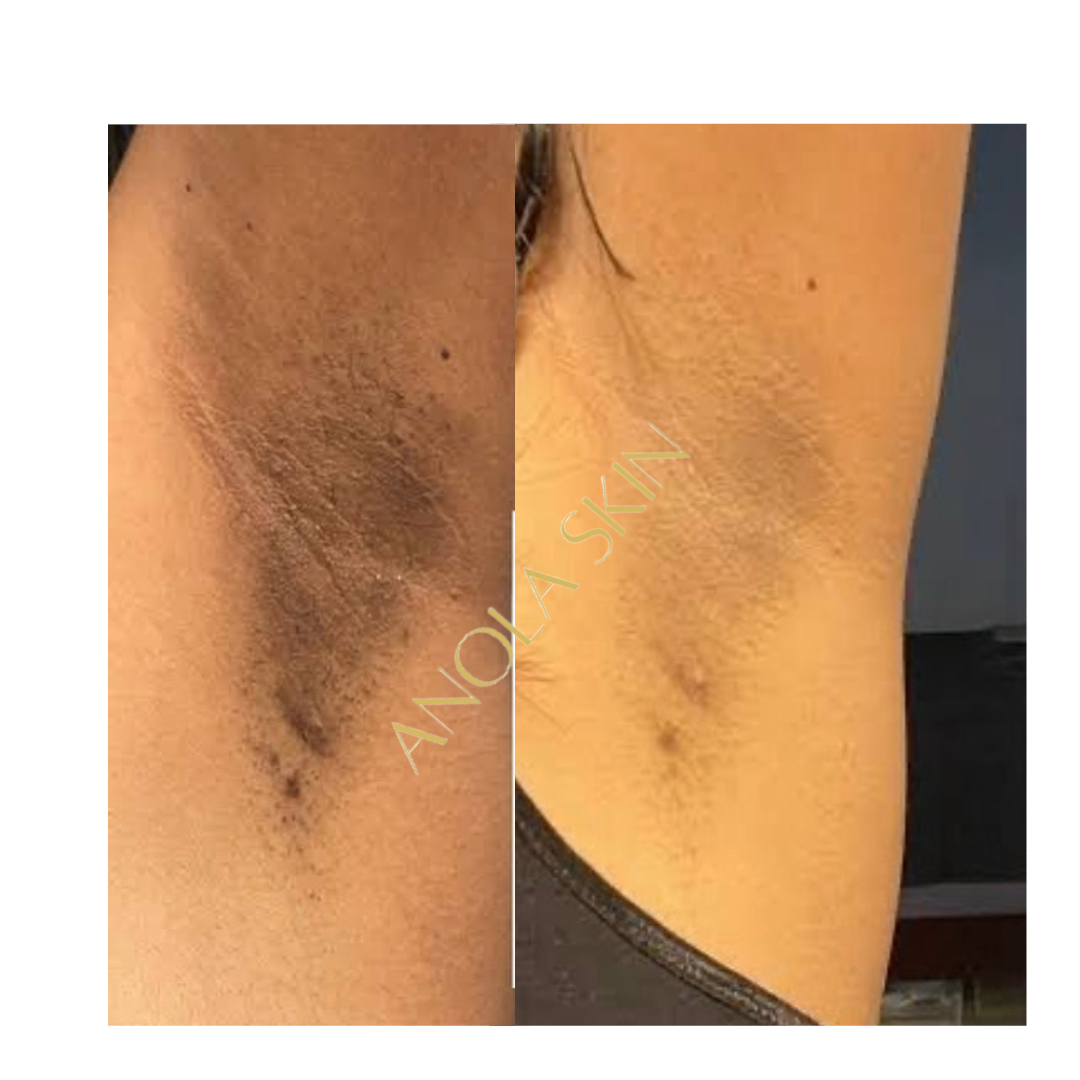 Intense Discoloration Treatment
