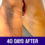 Intense Discoloration Treatment