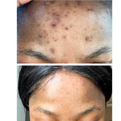 Intense Discoloration Treatment