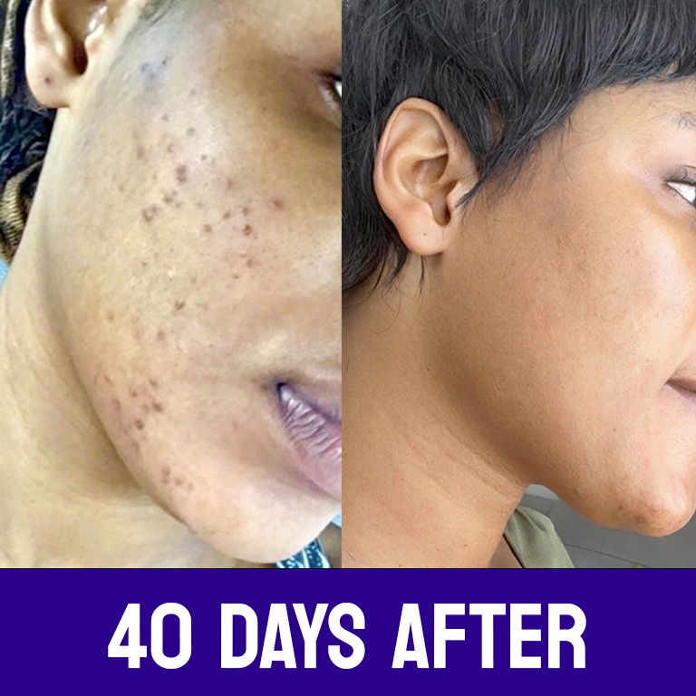 Intense Discoloration Treatment
