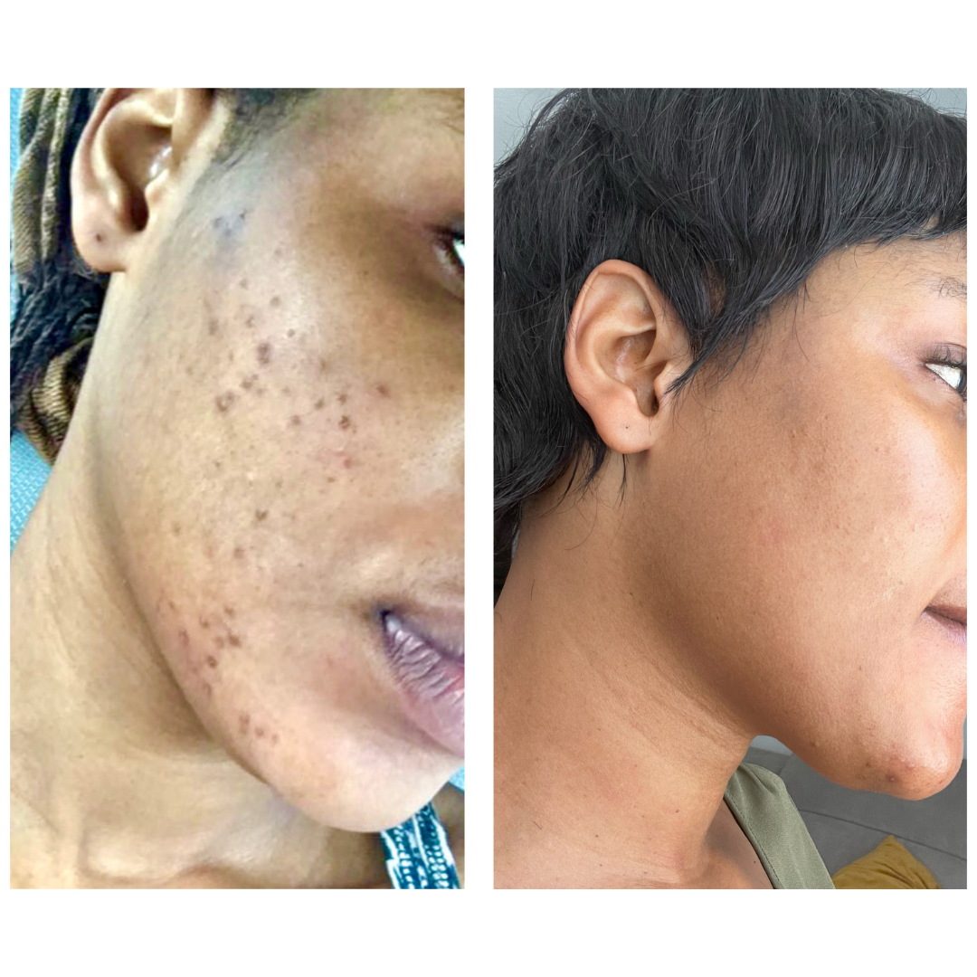 Intense Discoloration Treatment