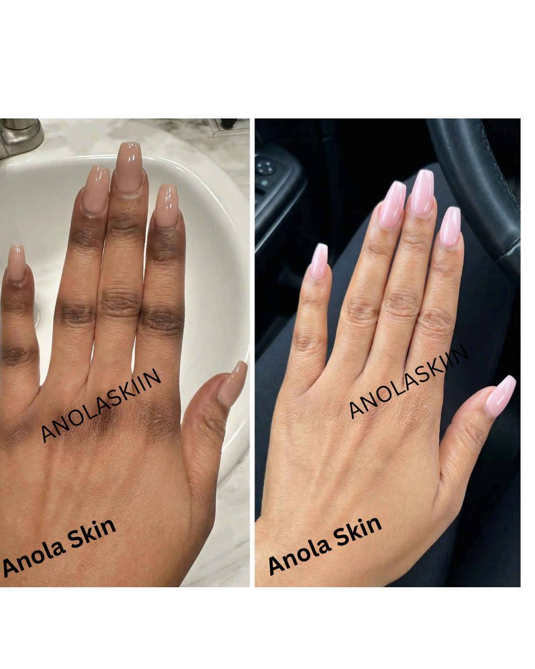 Rapid Fading Dark Knuckle Treatment (Results Driven )