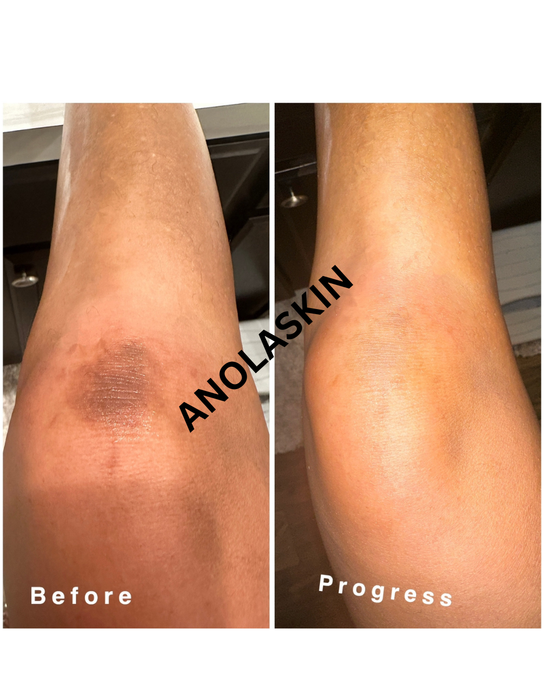 Rapid Fading Dark Knuckle Treatment (Results Driven )