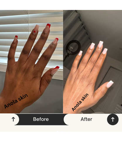 Rapid Fading Dark Knuckle Treatment (Results Driven )