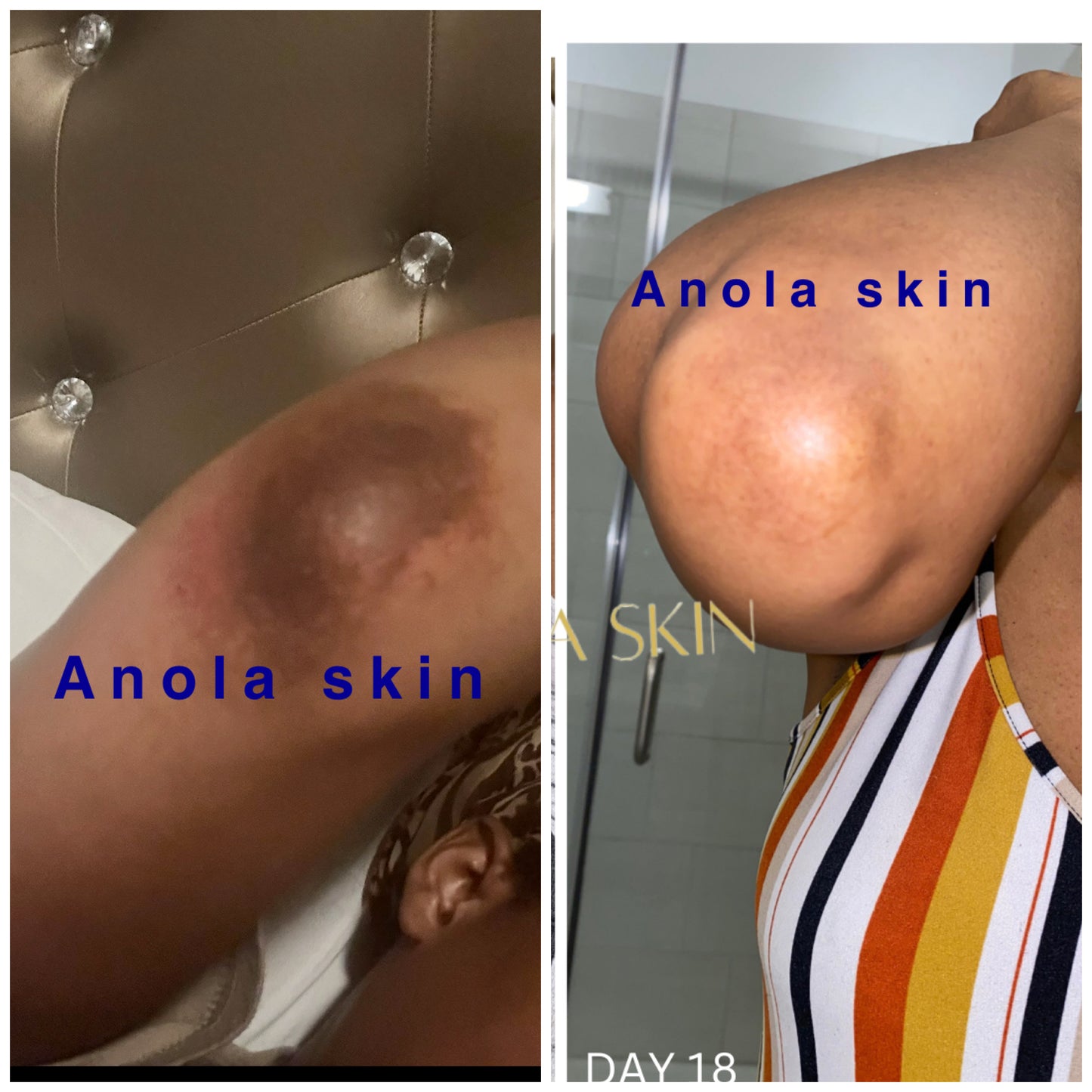 Dark Knuckle Treatment (Results Driven )