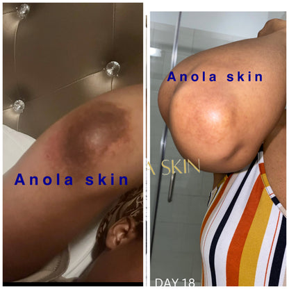 Dark Knuckle Treatment (Results Driven )