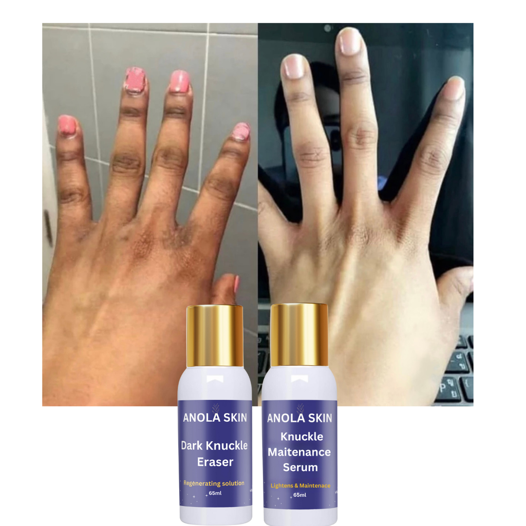 Rapid Fading Dark Knuckle Treatment (Results Driven )