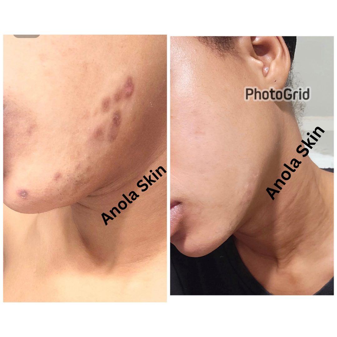 Intense Discoloration Treatment