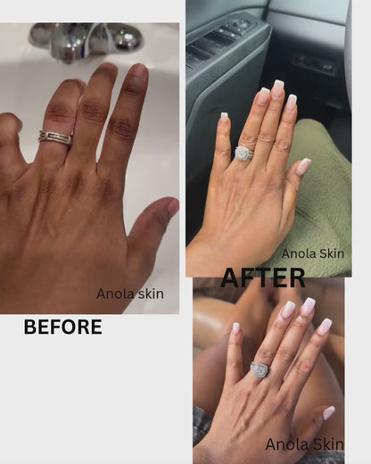 Rapid Fading Dark Knuckle Treatment (Results Driven )