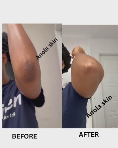 Rapid Fading Dark Knuckle Treatment (Results Driven )