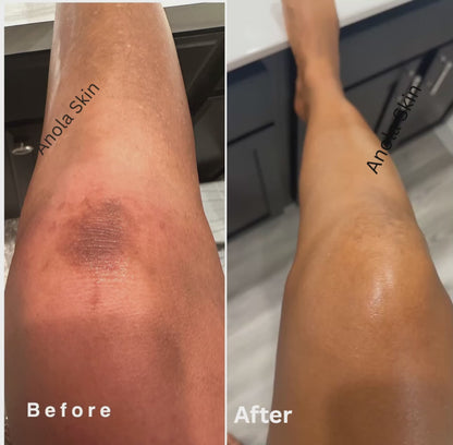 Rapid Fading Dark Knuckle Treatment (Results Driven )